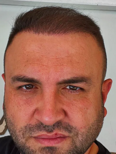 Gaziantep saç ekimi sonrası, vaka 1